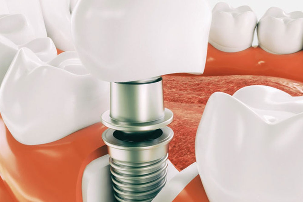 Precision Components for the Dental Industry